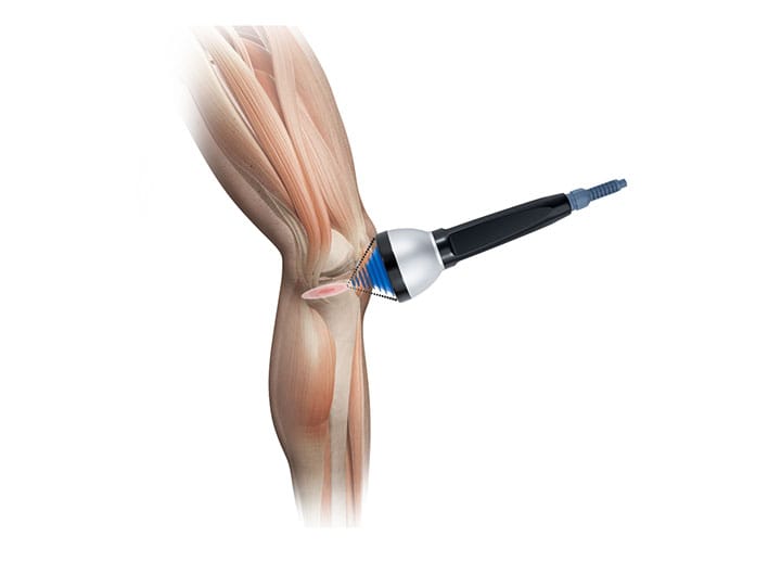 Bone-stress injuries