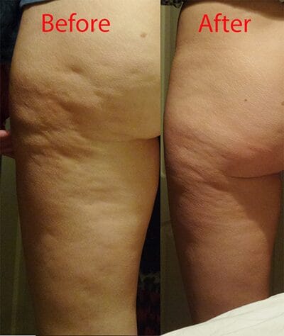 Cellulite reduction