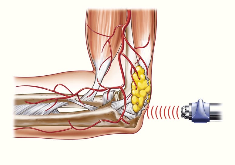 Muscle strain